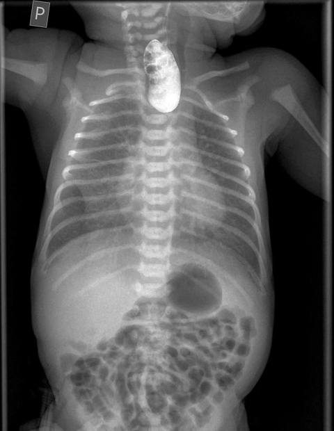 Oesophageal atresia in newborns: diagnosis, treatment, and perioperative management: a systematic review