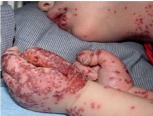 Viral skin infections in pediatric patients with atopic 
dermatitis – a single-center retrospective study
