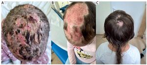 Figure from article: A case series on pediatric...