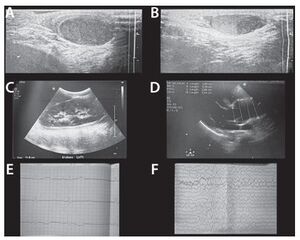 Treatment-related toxicities in acute lymphoblastic leukemia in a child with Marfan syndrome: a case report