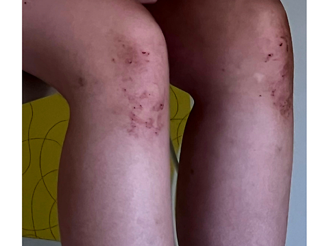 Figure from article: Coexistence of idiopathic...
